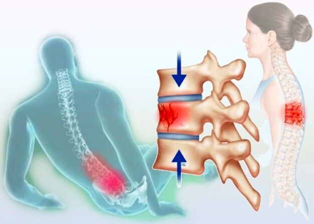 Lesio arrunt batek ere osteokondrosiaren garapena eragin dezake